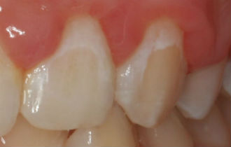 White spot lesions