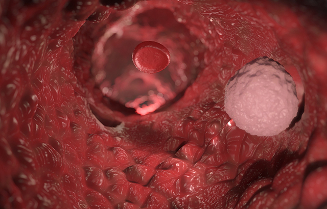 Metastasis - Invasion of cancer in the bloodstream