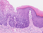 Microscope image of abnormal cells within the anus