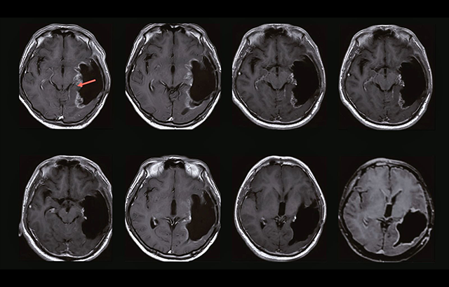 MRI brain scans of one of the trial participants who achieved a complete response. See original paper for more details. © Ning, W. et al. 2024 CC-BY 4.0