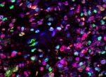 Glioblastoma under microscope with dyes.