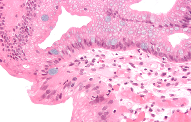 High-magnification micrograph of Barrett's oesophagus