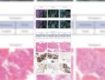 Molecular Imaging of the Adrenal Glands in 3 Patients