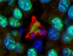 Tumour blood vessel endothelial cells (red), surrounded by tumour cell nuclei (blue and green). Red blood cells (green shapes) are visible in the centre of the blood vessel