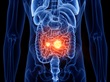 3d rendered medically accurate illustration of small intestine cancer By Sebastian Kaulitzki3d rendered medically accurate illustration of small intestine cancer By Sebastian Kaulitzki