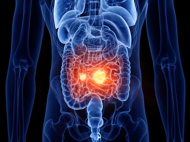 3d rendered medically accurate illustration of small intestine cancer by Sebastian Kaulitzki