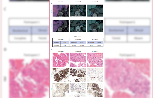 Molecular Imaging of the Adrenal Glands in 3 Patients