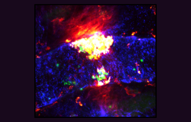 Image: A Portrait of a Fiery Blood Clot, Credit: Sammy El-Mansi, Queen Mary University of London, British Heart Foundation - Reflections of Research
