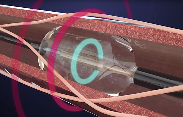 Renal denervation system