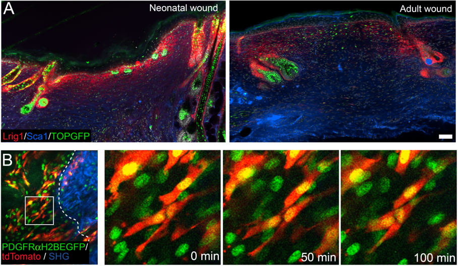 Figure 2: Fibroblast subpopulations during wound healing. (A) Exploring why skin regeneration ability decreases with age. There is a strong Wnt/β-catenin signalling activation (TOPGFP, green) in adult wound beds and placodes of regenerating hair follicles in neonatal wounds. In addition neonatal wounds show higher abundance of papillary fibroblasts (Lrig1, red) compared to reticular fibroblasts (Sca1, blue), which has strong implications for tissue regeneration. (B) In vivo live imaging of dermal fibroblast subpopulations during wound healing revealed how fibroblasts (nuclei, green; cytoplasm, red) polarise and migrate towards the wound bed centre in the early tissue repair phase.